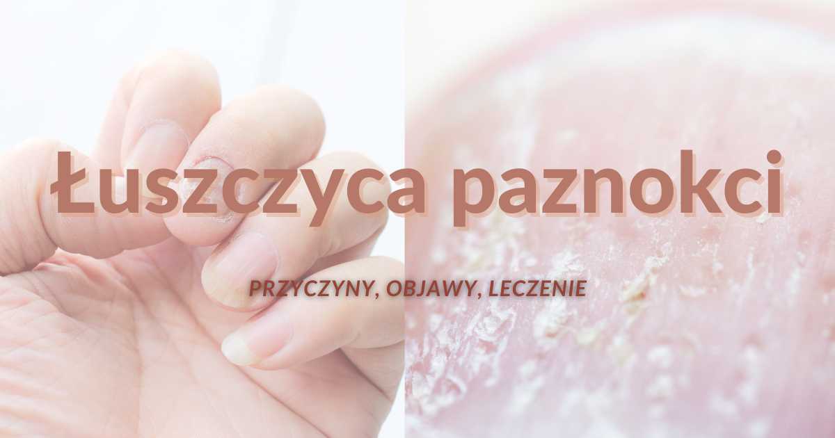 Co to jest łuszczyca paznokci?